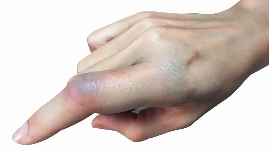 Wybity palec do jakiego lekarza? Sprawdź, jak uniknąć bólu i komplikacji