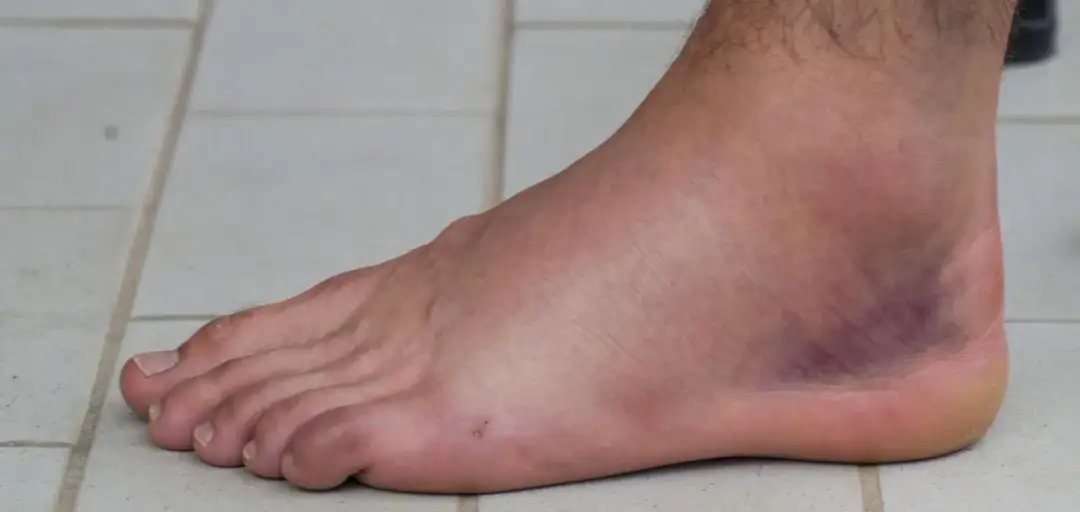 Co na skręcenie kostki: skuteczne metody łagodzenia bólu i leczenia