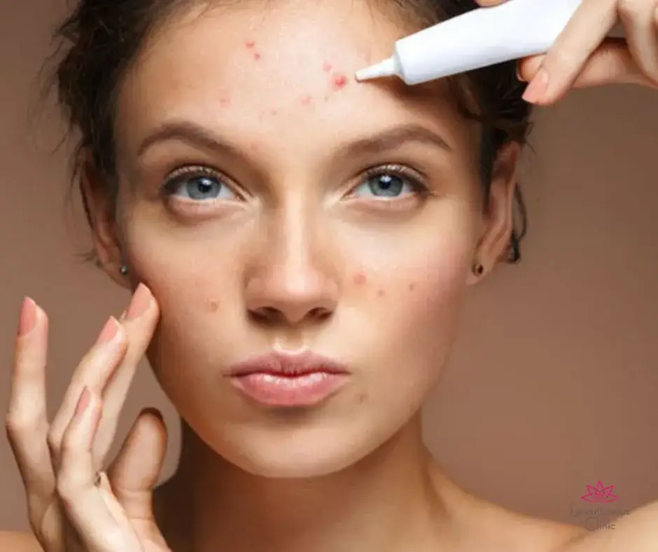 Co najlepsze na pryszcze? Skuteczne metody na trądzik i pielęgnację