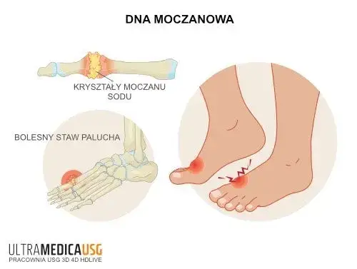 Dna moczanowa: Jak szybko i bezpiecznie zwalczyć ostry ból?
