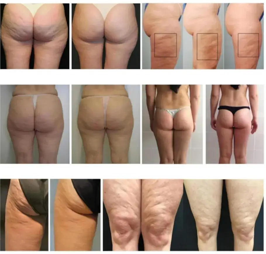 Skuteczne metody na cellulit - co jest dobre na cellulit i jak działać