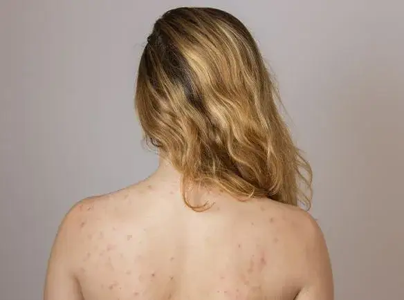 Pryszcze na plecach: Skuteczne sposoby na "bacne" - poradnik