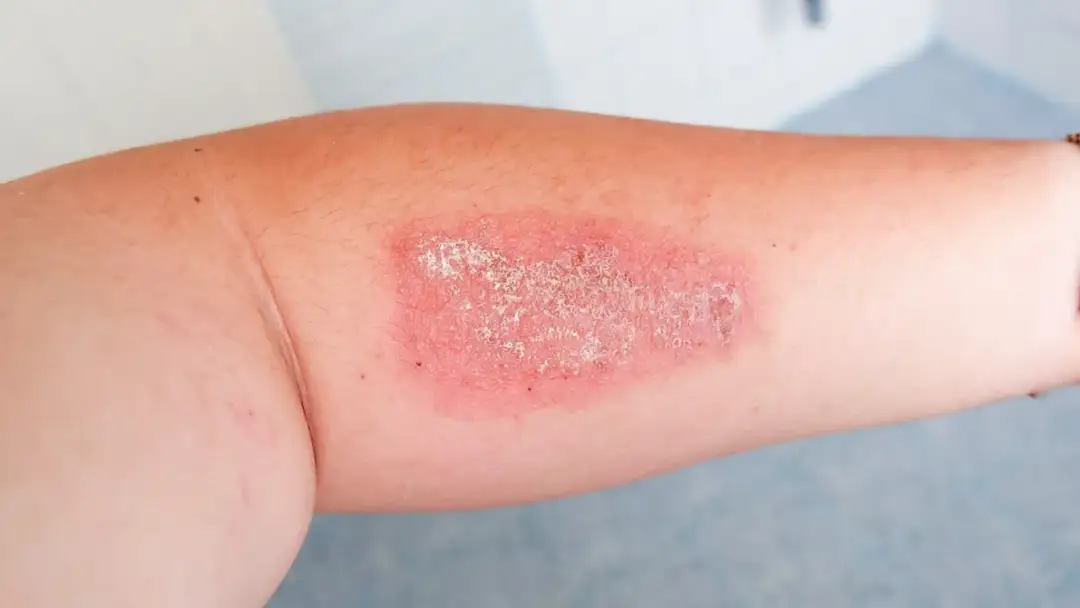 Gronkowiec MSSA - czy jest groźny? Objawy, leczenie, zapobieganie