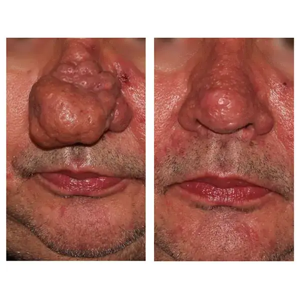 Skuteczne sposoby na pozbycie się pryszcza w nosie bez bólu