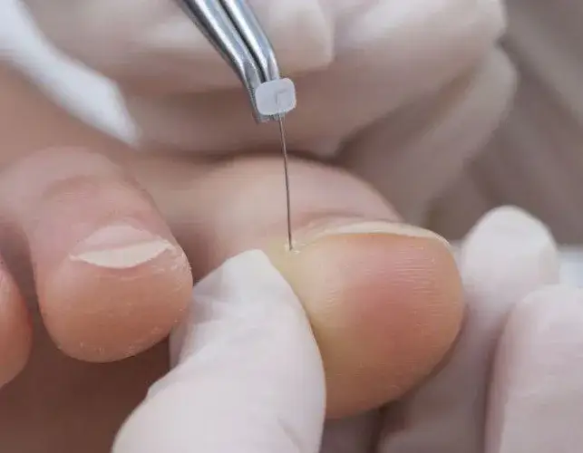 Jak długo nosić klamry na wrastające paznokcie? Czas leczenia i oczekiwania