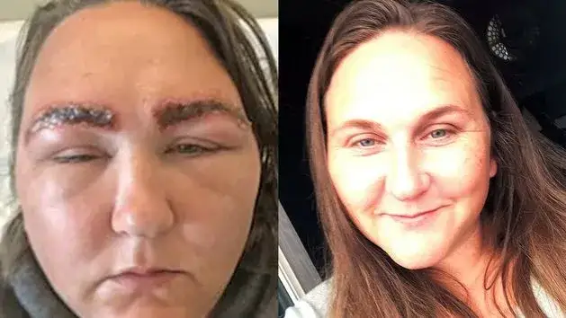 Henna do brwi na skórze? Ryzyko poparzeń i alergii na PPD!