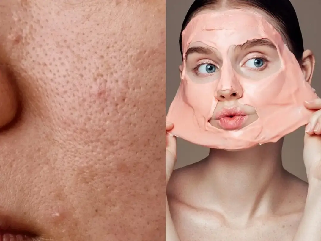 Jak wygląda zapchana cera? Objawy, przyczyny i skuteczne rozwiązania