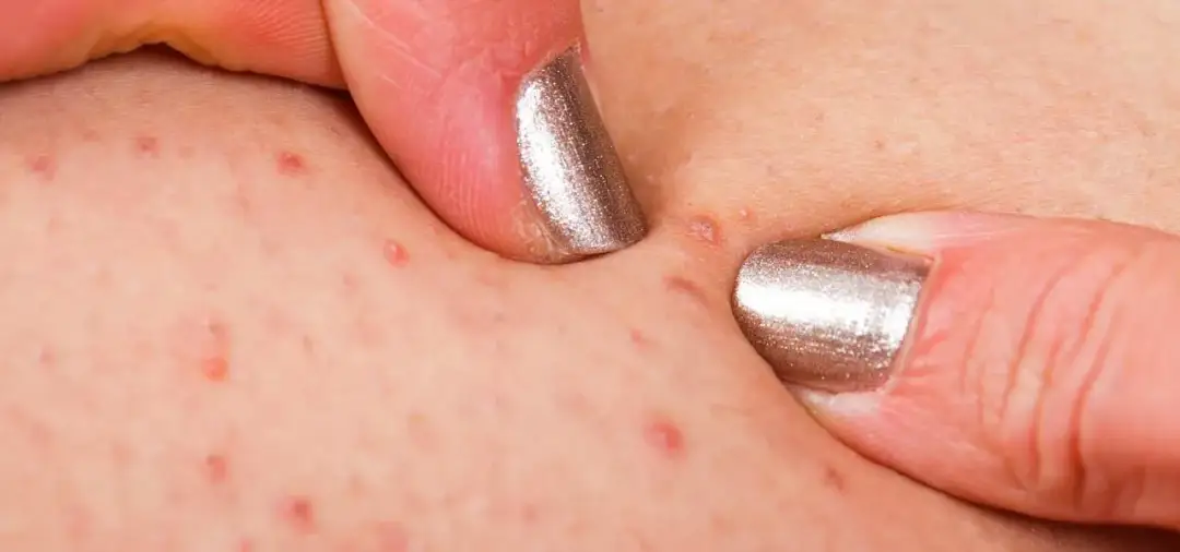 Zapalenie mieszków włosowych: Jak leczyć? Domowe i apteczne metody