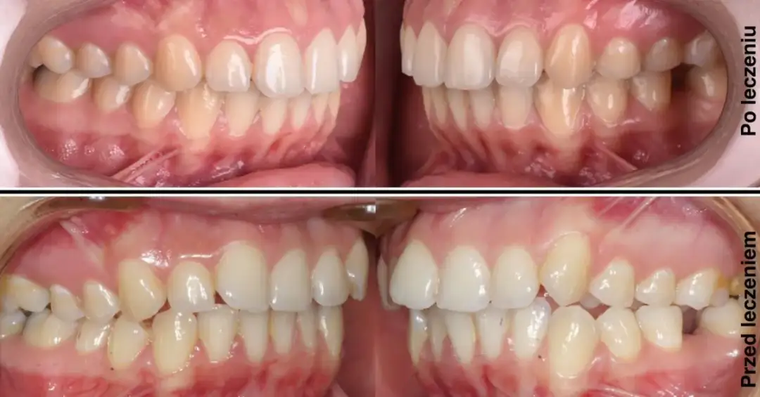 Czy aparat powiększa usta? Odkryj zaskakujące efekty noszenia aparatu