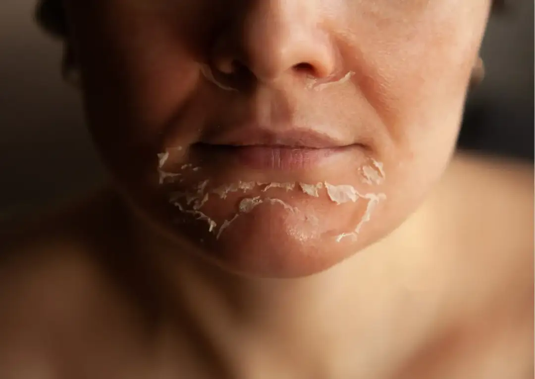 Jak wygląda twarz po kwasach? Najlepsze porady pielęgnacyjne