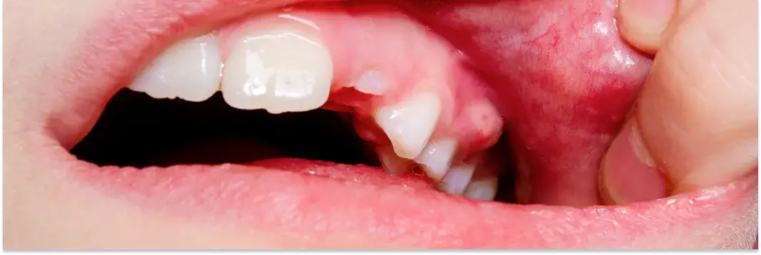 Opuchnięte dziąsła: Szybka ulga domowymi sposobami i kiedy do dentysty