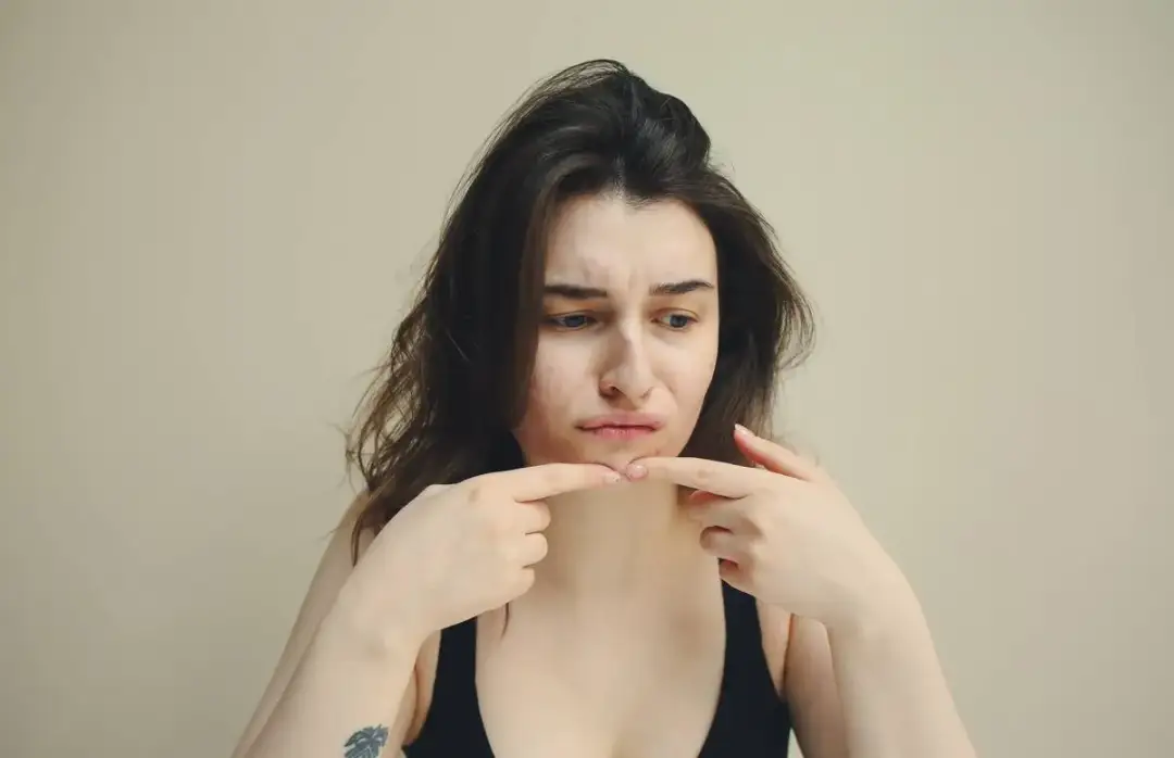 Skuteczne sposoby, co zrobić żeby nie mieć pryszczy i cieszyć się zdrową skórą