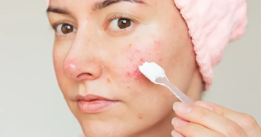 Skuteczne sposoby na pryszcze na twarzy – uniknij trądziku już dziś