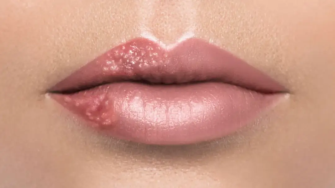 Czy z opryszczką można iść do dentysty? Poznaj ryzyko i zalecenia