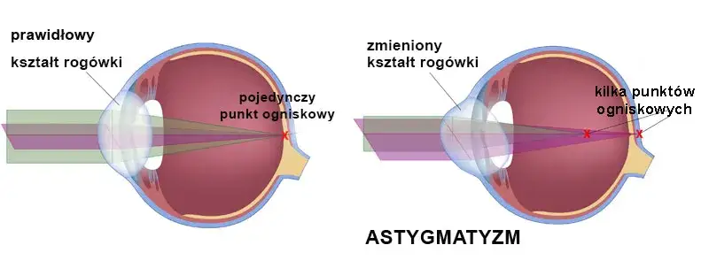 Czy wada wzroku to choroba? Poznaj prawdę o problemach ze wzrokiem