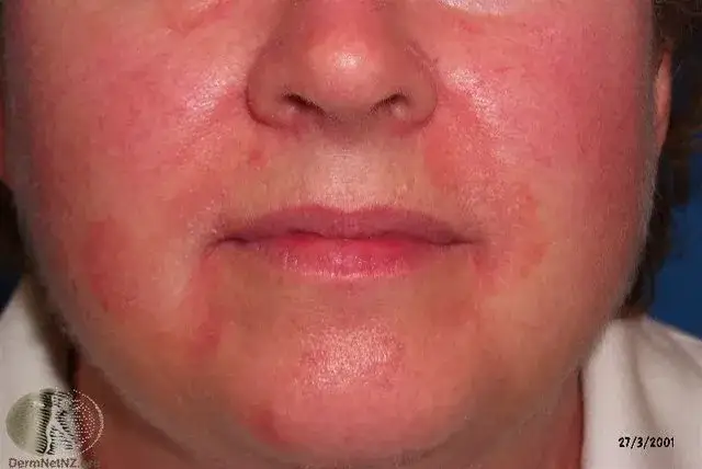 Rote Flecken im Gesicht: Ursachen, Behandlung & Soforthilfe