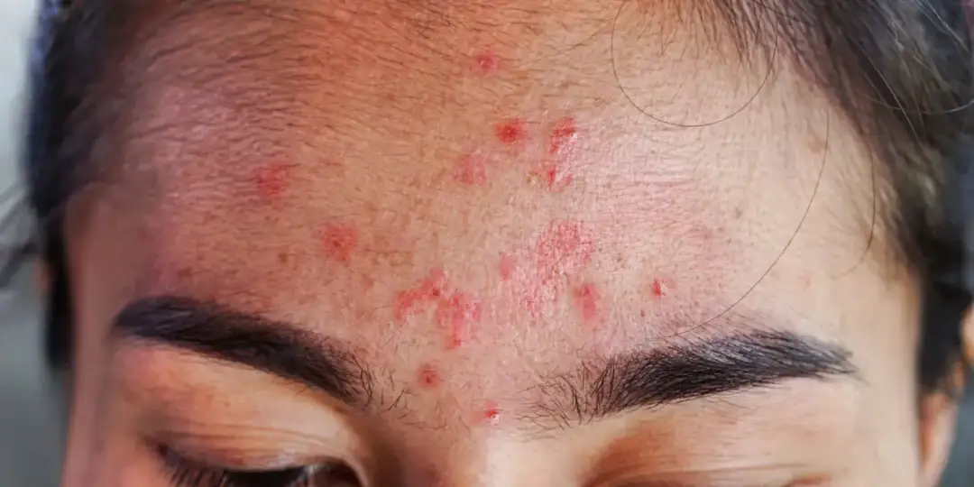 Czy pryszcze można wyciskać? Poznaj ryzyko i lepsze metody pielęgnacji