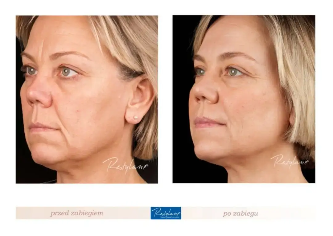 Bruzdy nosowo-wargowe: Efekty po kwasie hialuronowym kiedy i na jak długo?