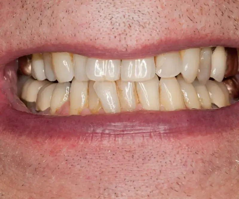 Czy żelazo niszczy zęby? Sprawdź, jak uniknąć przebarwień