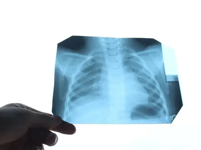 Pulmonolog co to za lekarz i jak może pomóc w chorobach płuc