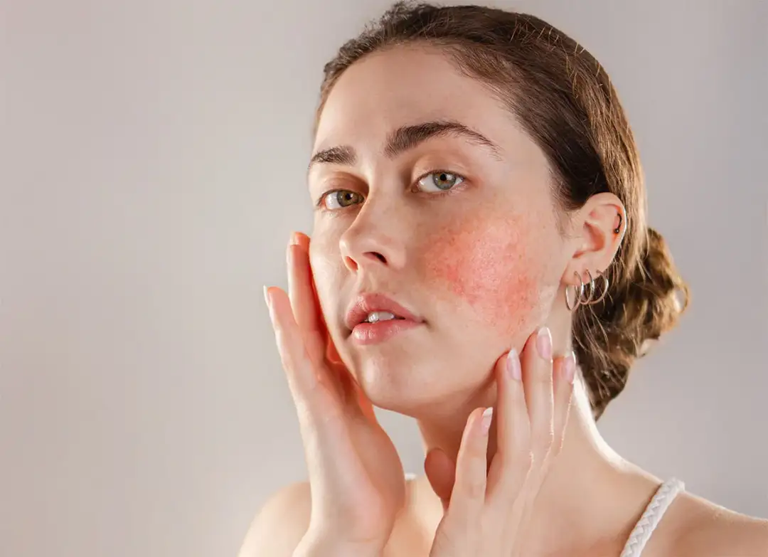 Gerötete Haut: Ursachen, Soforthilfe & die richtige Pflege | [Dein Name]