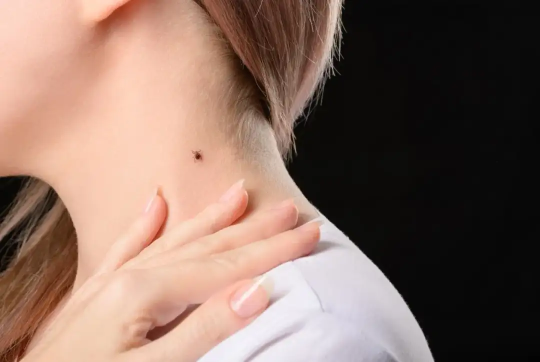 Mały kleszcz na szyi. Jak odróżnić kleszcza od pieprzyka? Dłoń dotyka skóry, by sprawdzić obecność pasożyta.