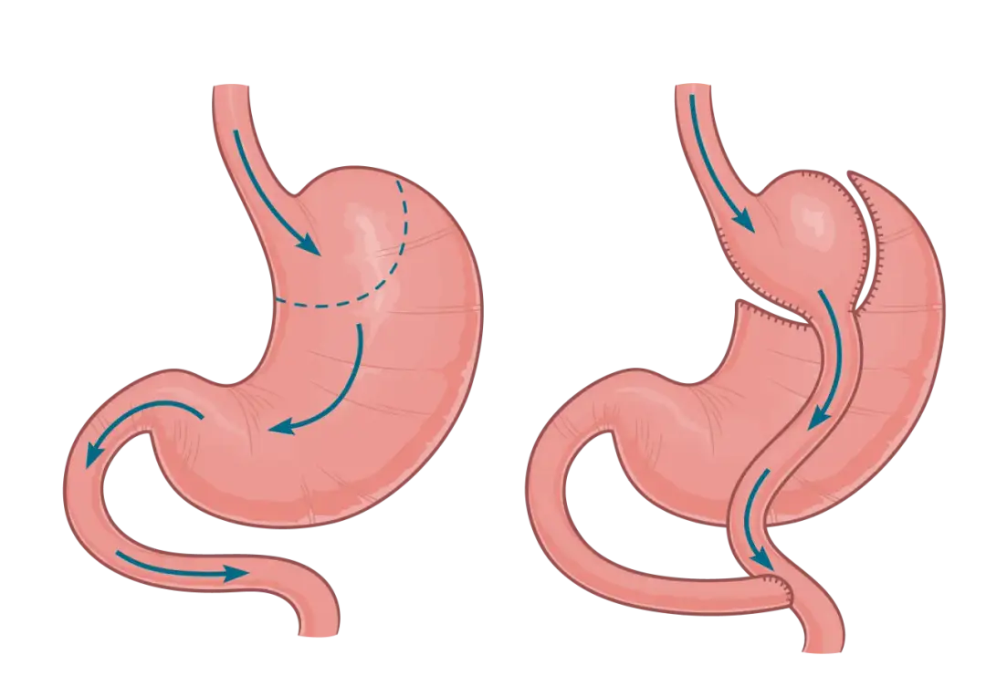 Operacja sleeve to Twoja droga do trwałej redukcji masy ciała?