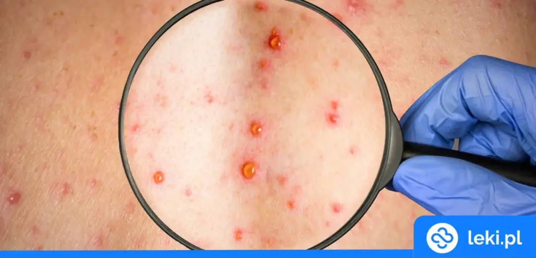 Ospa: Paracetamol jedyny na gorączkę! Unikaj ibuprofenu.