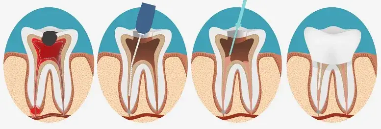 Ból po leczeniu kanałowym: Kiedy jest normalny, a kiedy alarm?