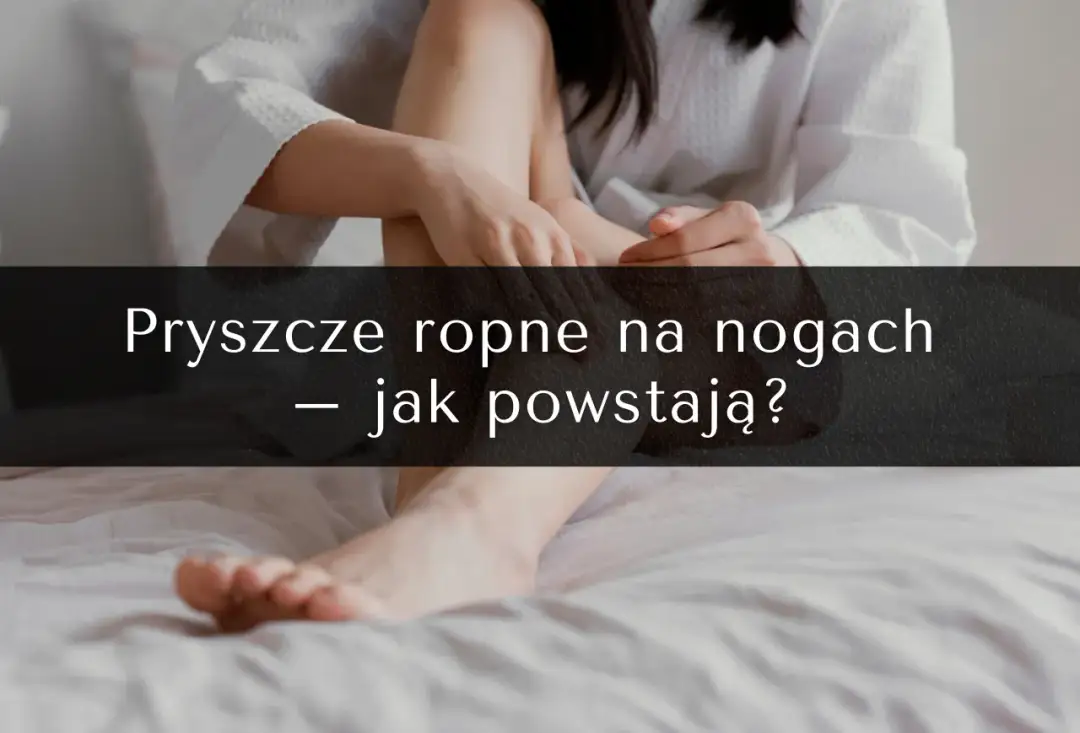 Pryszcze na nogach: przyczyny, skuteczne metody leczenia i profilaktyka