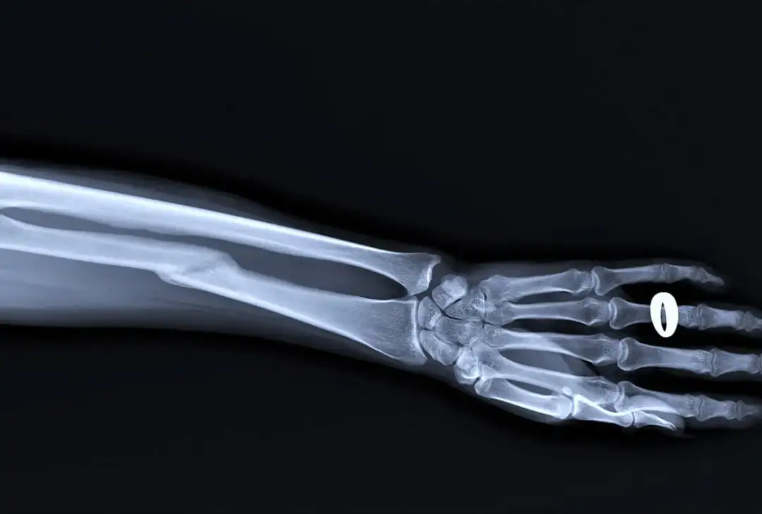 Złamanie kości promieniowej z przemieszczeniem: skuteczne leczenie