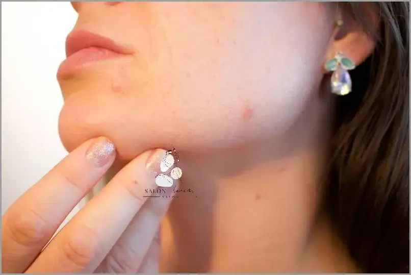 Jak szybko usunąć pryszcza podskórnego - skuteczne metody na ulgę