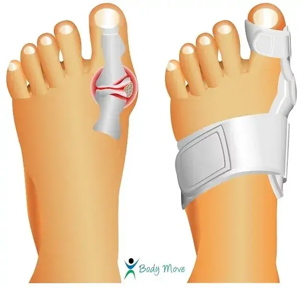 Co na haluksy do butów? Skuteczne sposoby na ból i komfort