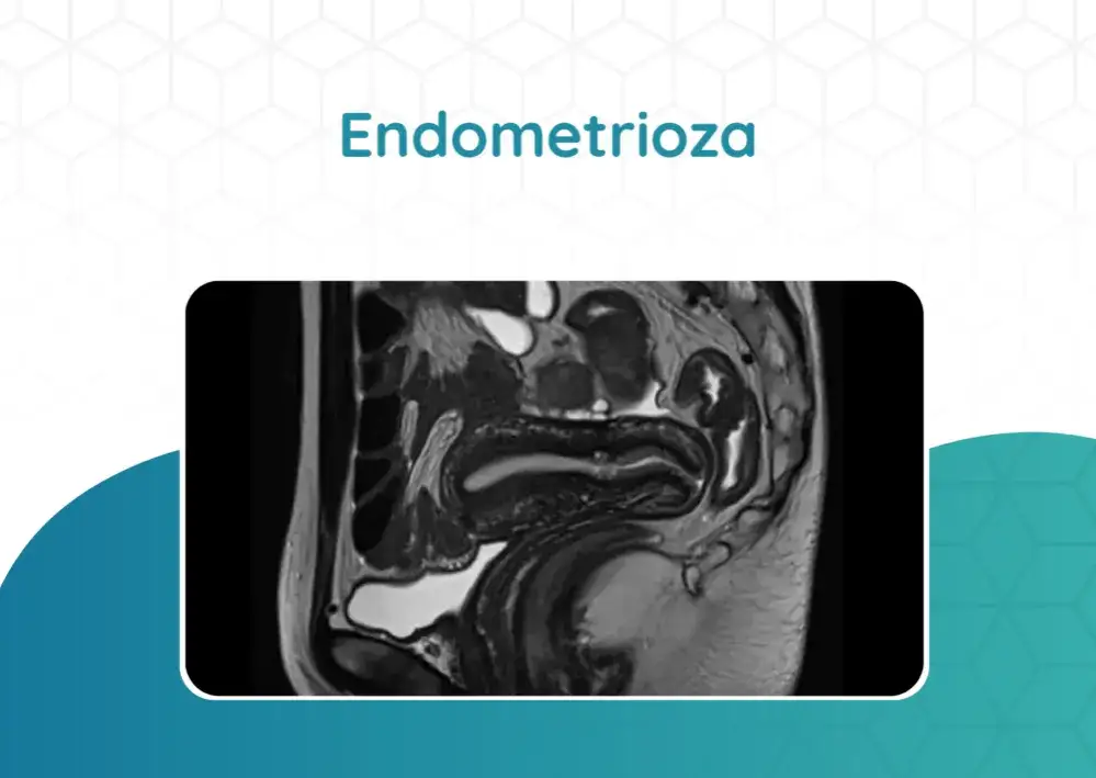 Jakie badanie na endometriozę? Kluczowe metody diagnozowania tej choroby