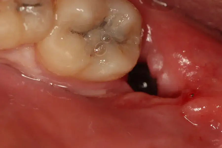 Co w zębodole po wyrwaniu zęba? Tajemnice gojenia i Twoja rola.