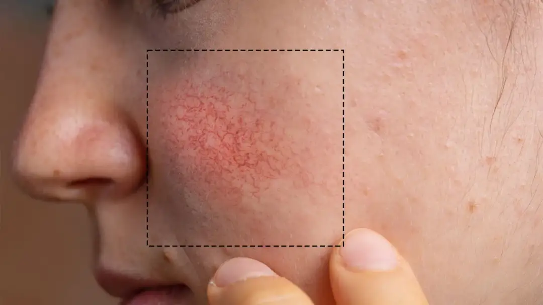 Czego unikać przy cerze naczynkowej, aby uniknąć podrażnień?