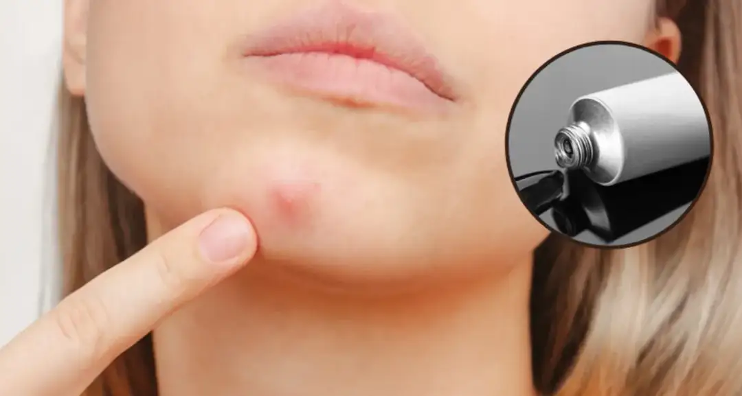 Jak pozbyć się pryszcza który jeszcze nie wyszedł i uniknąć blizn