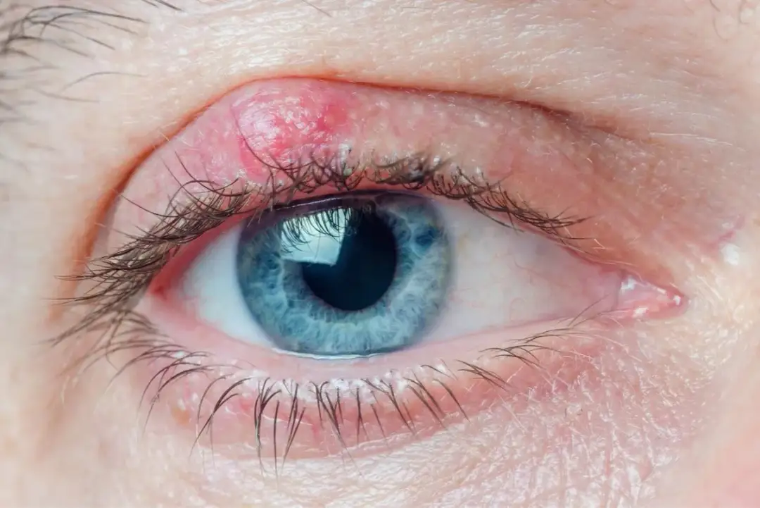 Guz wewnątrzgałkowy objawy – jak rozpoznać i kiedy zgłosić się do lekarza?