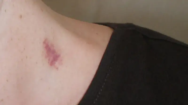 Jak zrobić sobie samemu malinkę bez ryzyka bólu i kontuzji