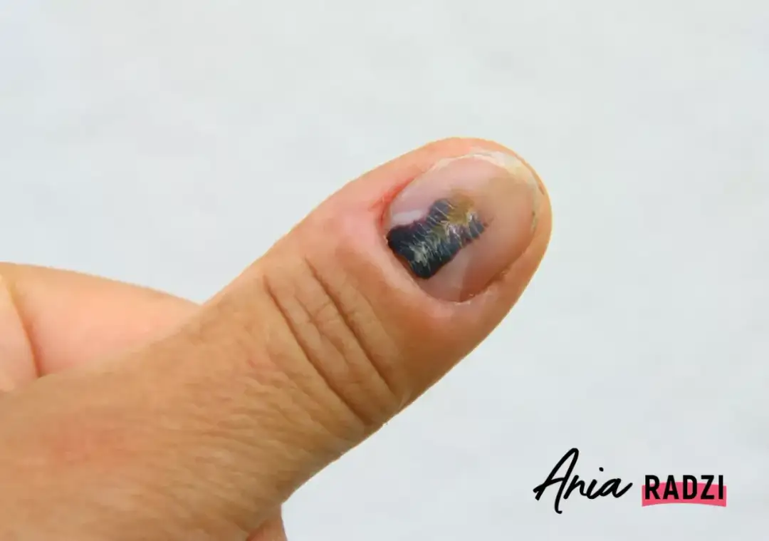 Stłuczony paznokieć: jak leczyć? Kiedy do lekarza, a kiedy domowe sposoby?