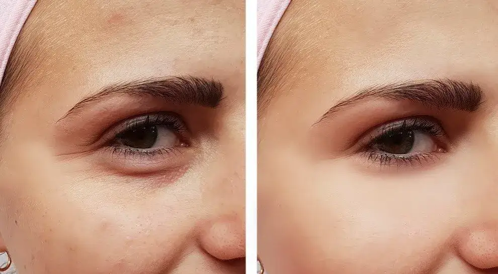 Jak wygląda twarz po mikrodermabrazji? Efekty i reakcje skórne