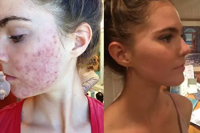 Jak pozbyć się pryszczy? Przewodnik eksperta: dieta, pielęgnacja