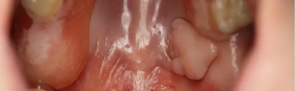 Jak wygląda włókniak w jamie ustnej? Objawy i charakterystyka zmian