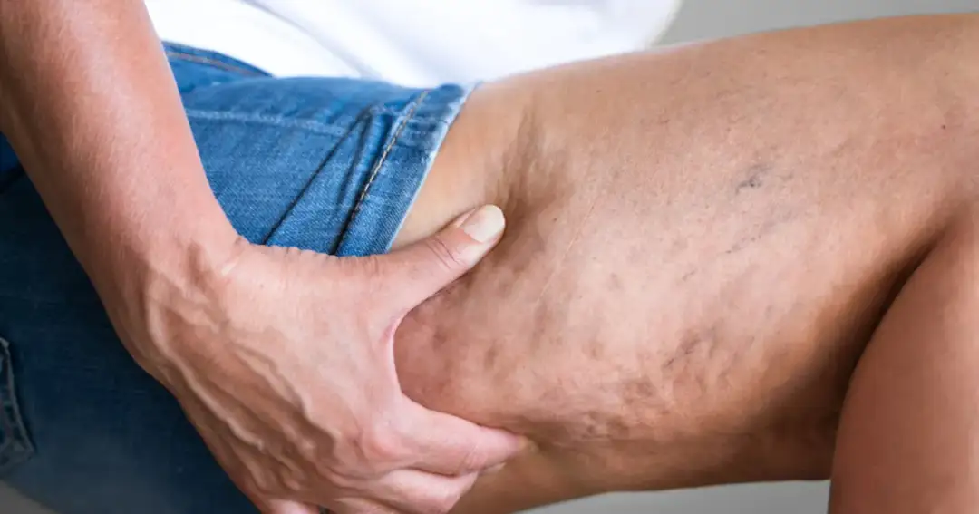 Skuteczna walka z cellulitem: Domowe sposoby i profesjonalne zabiegi