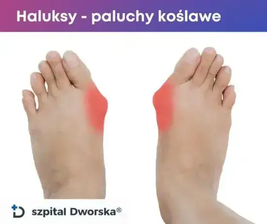 Ile kosztuje operacja haluksów? Cennik NFZ vs. Prywatnie 2025