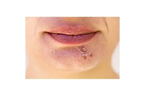 Skuteczne leki na opryszczkę bez recepty – ulga w objawach i leczeniu