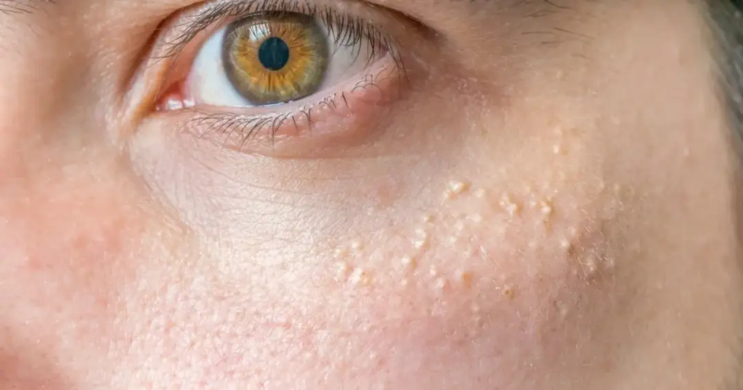 Skuteczne sposoby, jak usunąć pryszcze z twarzy i odzyskać gładką skórę