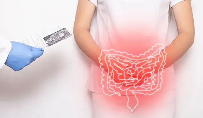 Jak leczyć zapalenie jelita grubego - skuteczne metody i porady