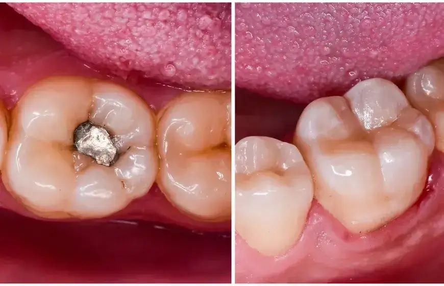 Ile kosztuje plomba na NFZ? Sprawdź, co musisz wiedzieć o dopłatach