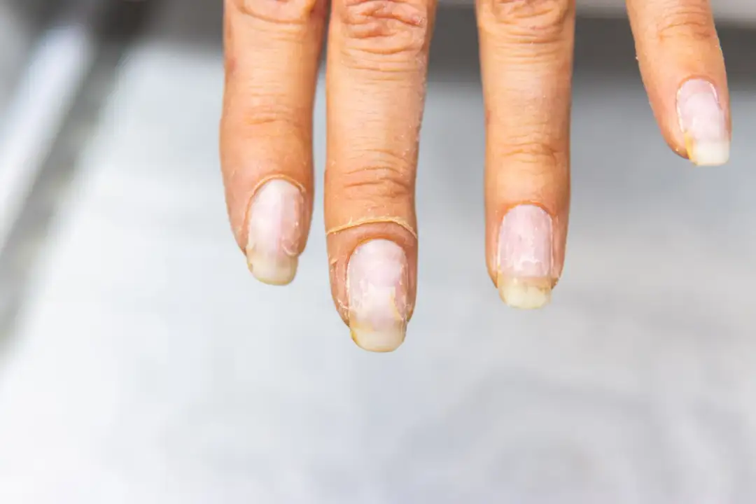 Onycholiza - jak sobie z nią radzić i jakie preparaty wybrać?